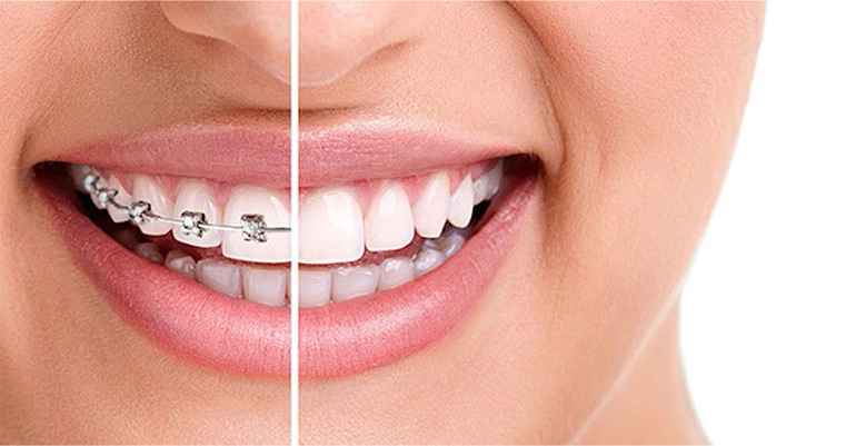 Dental Braces Ottawa - Starting at $5,495 with no interest monthly payments  - Sunset Dental Centre - Ottawa, Greely ON