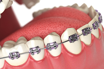 orthodontics----braces---illustration