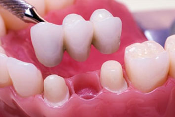Shoreham-Dental-crowns-bridges-354x236